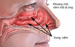 Viêm mũi dị ứng Triệu chứng, chẩn đoán và cách điều trị