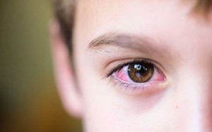 Bệnh khô mắt do thiếu Vitamin A Những điều cần biết trong chẩn đoán và điều trị