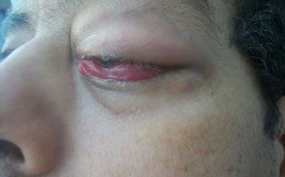 Viêm tổ chức hốc mắt Dấu hiệu triệu chứng và phác đồ điều trị