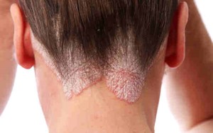 Bệnh nấm tóc và cách phòng trị