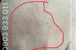 MẦN NGỨA BÀN TAY KÉO DÀI 4 NĂM! PHẢI LÀM SAO ĐỂ HẾT NGỨA?