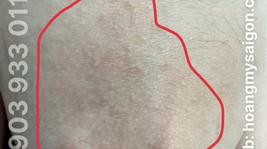 MẦN NGỨA BÀN TAY KÉO DÀI 4 NĂM! PHẢI LÀM SAO ĐỂ HẾT NGỨA?