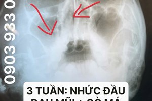 VIÊM MŨI XOANG CÓ CÁCH NÀO ĐIỀU TRỊ DỨT ĐIỂM ?