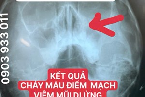 TRẺ EM - 2 THÁNG CHẢY MÁU MŨI HO KÉO DÀI NÊN MUA THUỐC UỐNG HAY ĐI KHÁM BS?