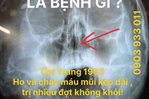 Ho Kéo Dài, Chảy Máu Mũi Nhiều Lần: Cảnh Báo Bệnh Lý Mũi Xoang Không Nên Chủ Quan