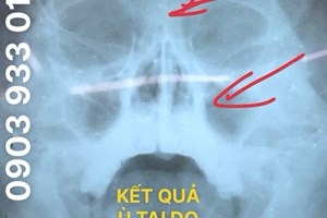 Ù TAI , CHÓNG MẶT KÉO DÀI CÁCH CHỮA TRỊ HIỆU QUẢ !