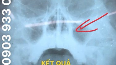 Ù TAI , CHÓNG MẶT KÉO DÀI CÁCH CHỮA TRỊ HIỆU QUẢ !