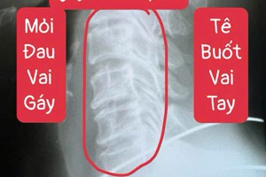 Dấu Hiệu Thoái Hóa Cột Sống Cổ Nặng: Nhận Biết Sớm Để Tránh Biến Chứng