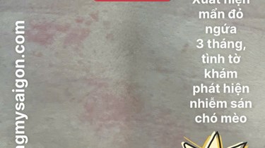 Ngứa Dai Dẳng Suốt Ngày: Cảnh Báo Nhiễm Ký Sinh Trùng Mà Nhiều Người Không Ngờ Tới