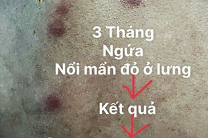 Ngứa Kéo Dài 3 Tháng, Phát Hiện Nhiễm Đồng Thời 2 Loại Ký Sinh Trùng