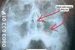 KHI BỊ CHẢY MÁU MŨI KÉO DÀI LÀM SAO TRỊ DỨT ĐIỂM?