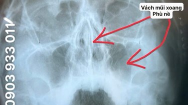KHI BỊ CHẢY MÁU MŨI KÉO DÀI LÀM SAO TRỊ DỨT ĐIỂM?