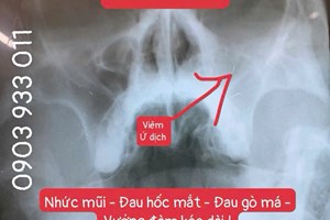 Dấu Hiệu Nhận Biết Viêm Xoang Và Cách Phòng Ngừa Tái Phát