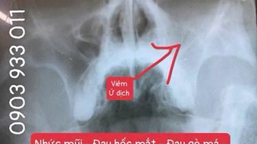 Dấu Hiệu Nhận Biết Viêm Xoang Và Cách Phòng Ngừa Tái Phát