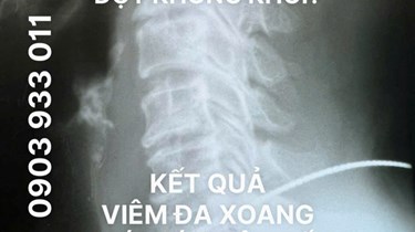 ĐAU MỎI VAI GÁY CHÓNG MẶT Ù TAI KÉO DÀI ĐIỀU TRỊ NHIỀU ĐỢT KHÔNG KHỎI! LÀ BỆNH GÌ? CÓ NGUY HIỂM KHÔNG?