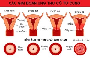 Những điều cần biết về phòng ngừa ung thư cổ tử cung