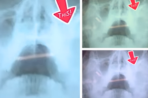 Khám sức khỏe tổng quát phát hiện đa bệnh - Anh Hà sinh năm 1979 quận 12