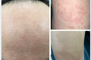 Khám sức khỏe tổng quát phát hiện bệnh nhiễm ký sinh trùng - bệnh nhân Anh Trung sinh năm 1994 tại Gò Vấp